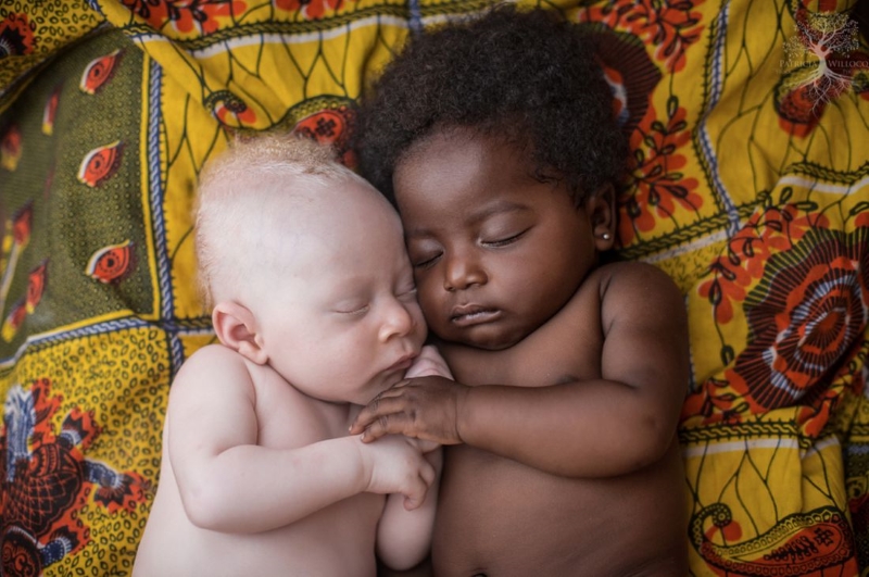 Fotografias de Patricia Willocq Combatem a Discrimição de Albinos na África