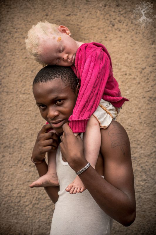 Criança albina