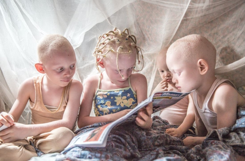 Crianças albinas